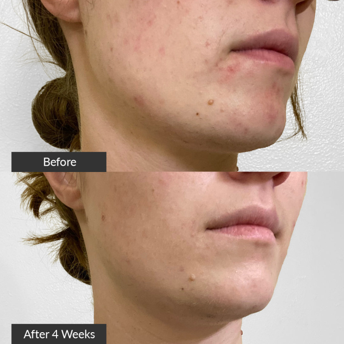 Izgled lica prije i nakon tretmana akni s PMD Acne Clean uređajem